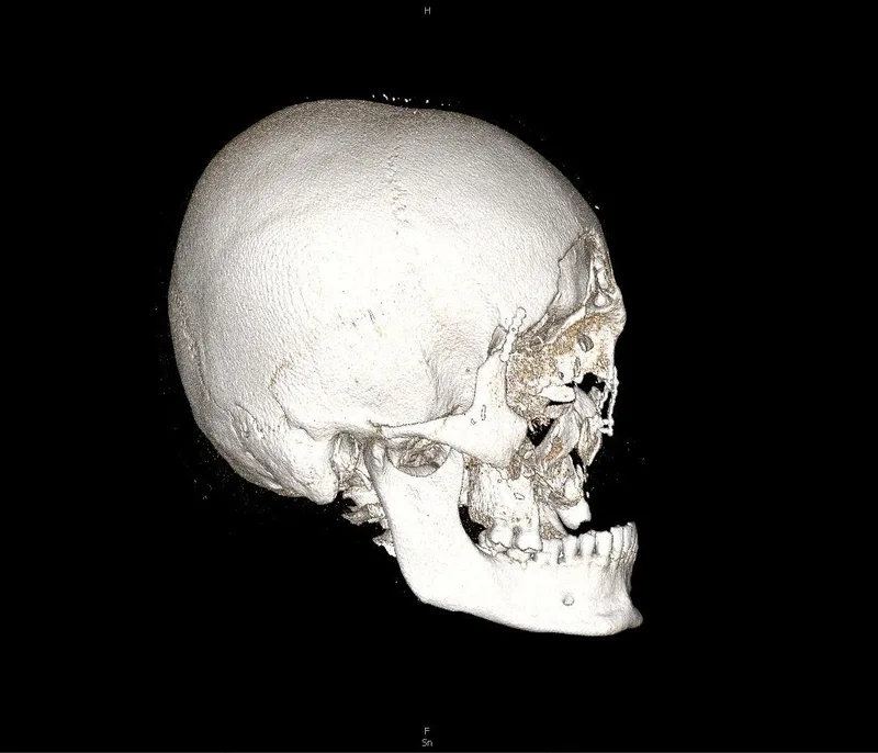 Kriegsverwundung: Ein im Krieg verwundeter 27-jähriger Soldat mit
Verlust des Oberkiefers und damit einhergehendem Verlust der vertikalen
Relation und der Lippenkontur.