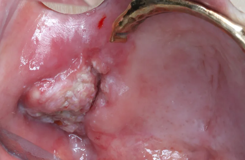 Abb. 1: Situation unmittelbar präoperativ. Die Ausdehnung und Lage des Tumors lassen eine großflächige Mund-Antrum-Verbindung erwarten.