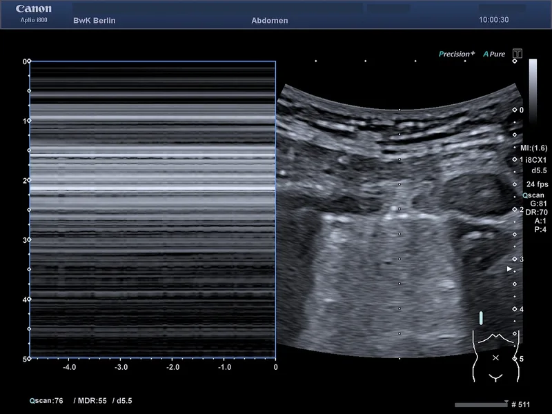 Ultraschallbild eines Pneumothorax im M-Modus, aufgenommen mit einem Canon Aplio i800 im Bundeswehrkrankenhaus Berlin