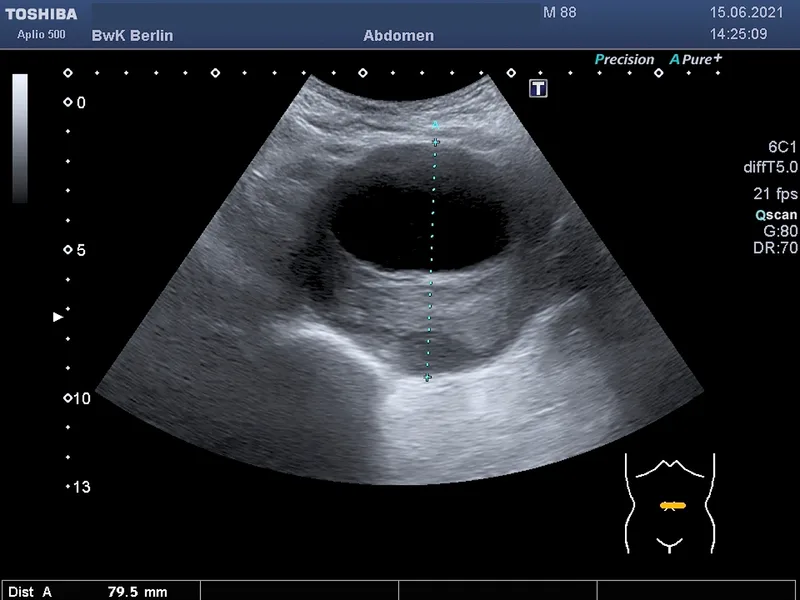 Sonographie eines 80 Millimeter großen Bauchaortenaneurysmas im Abdomen, aufgenommen mit einem Toshiba Aplio 500 im Bundeswehrkrankenhaus Berlin