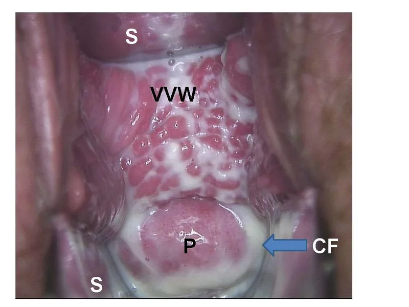 Medizinische Aufnahme einer Candida-Kolpitis mit weißlichen Belägen an Vaginalwand und Muttermund, markiert durch Buchstaben und Pfeile