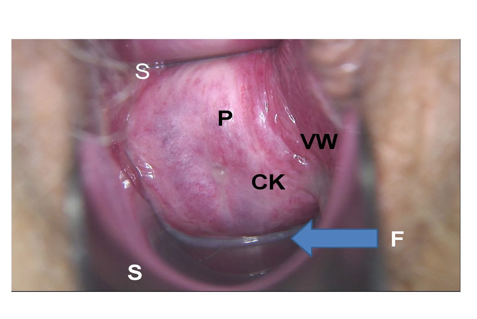 Abb. 1: Kolposkopisches Bild einer bakteriellen Vaginose. S= Spekulum, P = Portio, CK = Zervikalkanal (roter Kreis), VW = Vaginalwand, F = grünweißlich Fluor (Pfeil)