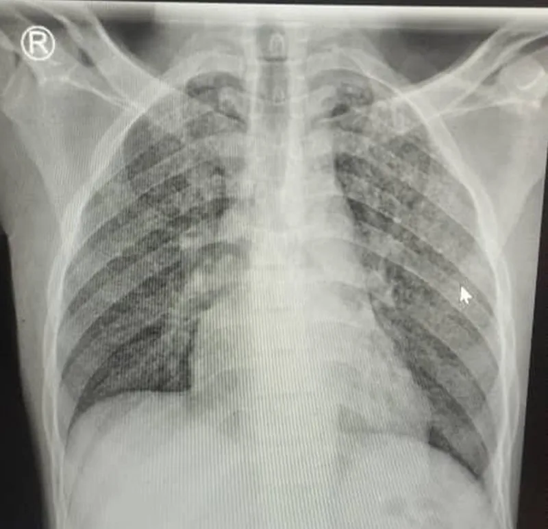 Digitale Röntgenaufnahme eines menschlichen Thorax mit Lunge, Rippen und Schlüsselbeinen auf einem Monitor dargestellt
