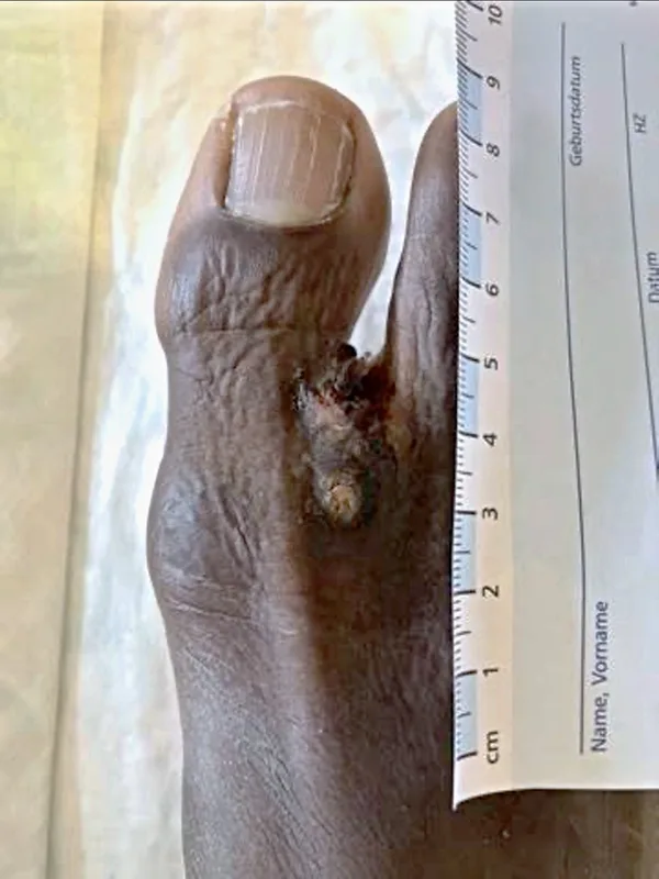 Fig. 1: Initial Findings (Eumycetoma): Individually grouped, ulcerated, exophytic nodules with overlying serocrusts in an area measuring approximately 2 x 1 cm (Image rights: Department of Dermatology, BwKrhs Hamburg)