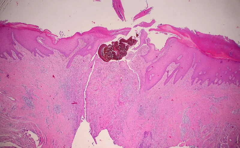 Fig. 2: Eumycetoma: More severe inflammatory infiltrate and fibroses with encapsulated granuloma-like dense, granulocytic inflammatory infiltrates (Image rights: Dermatohistopathology Dr. Günzl, Hamburg)
