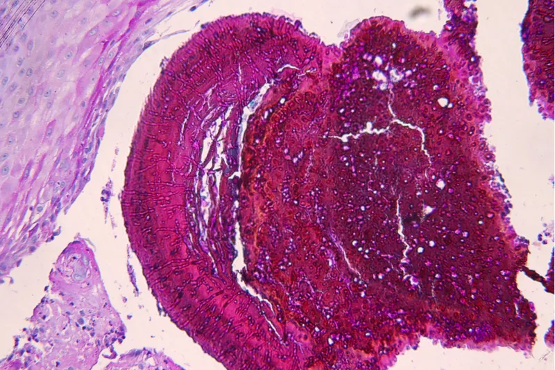 Fig. 3: Eumycetoma: Large granules with hyphae in a brownish matrix (Image rights: Dermatohistopathology Dr. Günzl, Hamburg)