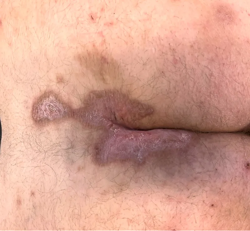Fig. 6: Cutaneous Leishmaniasis (Final Findings): Healing with scar formation (Image rights Department of Dermatology, BwKrHs Hamburg)