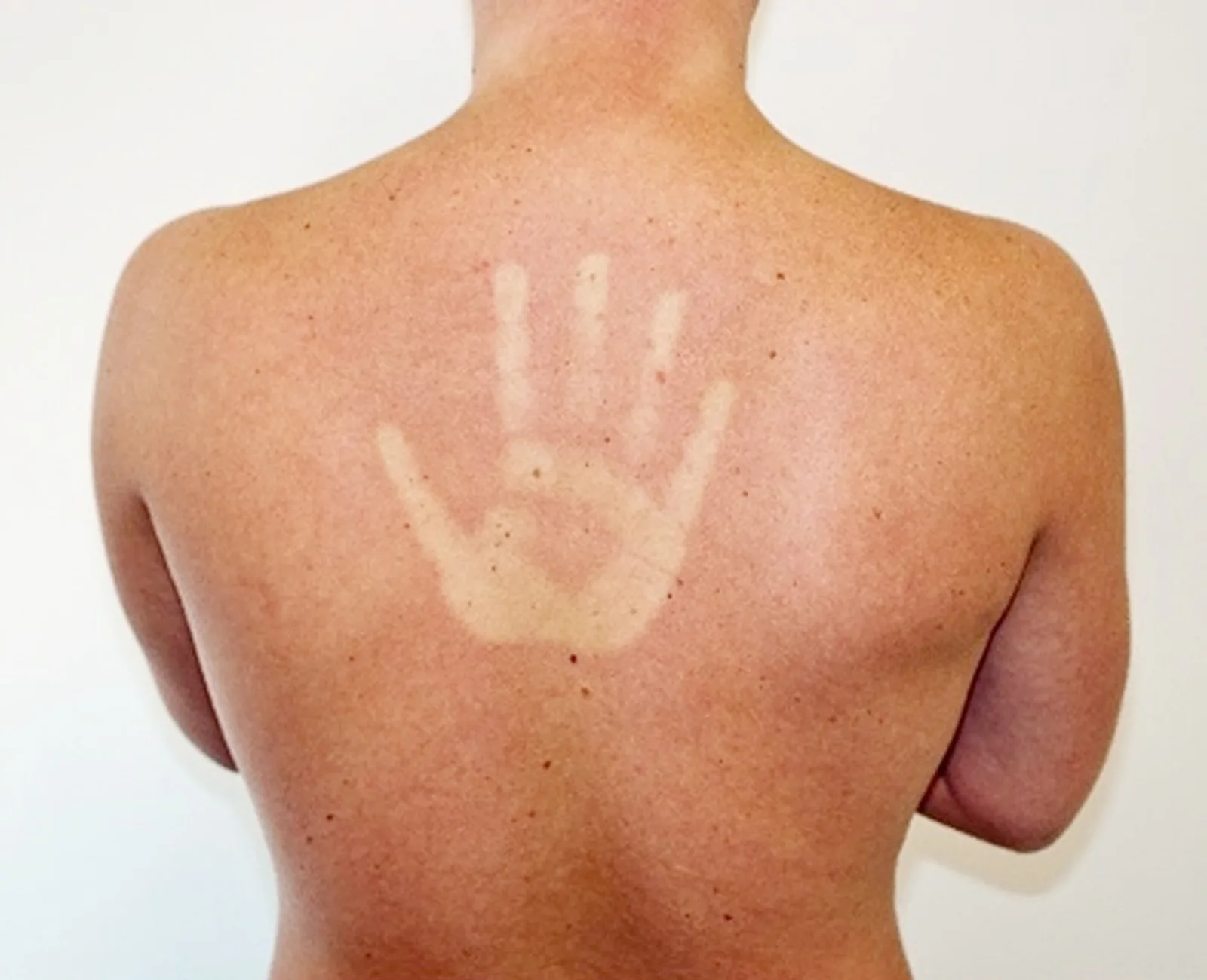 Rückenansicht einer Person mit großflächiger Hautrötung und einer hellen, handförmigen Aussparung infolge von UV-Strahlung