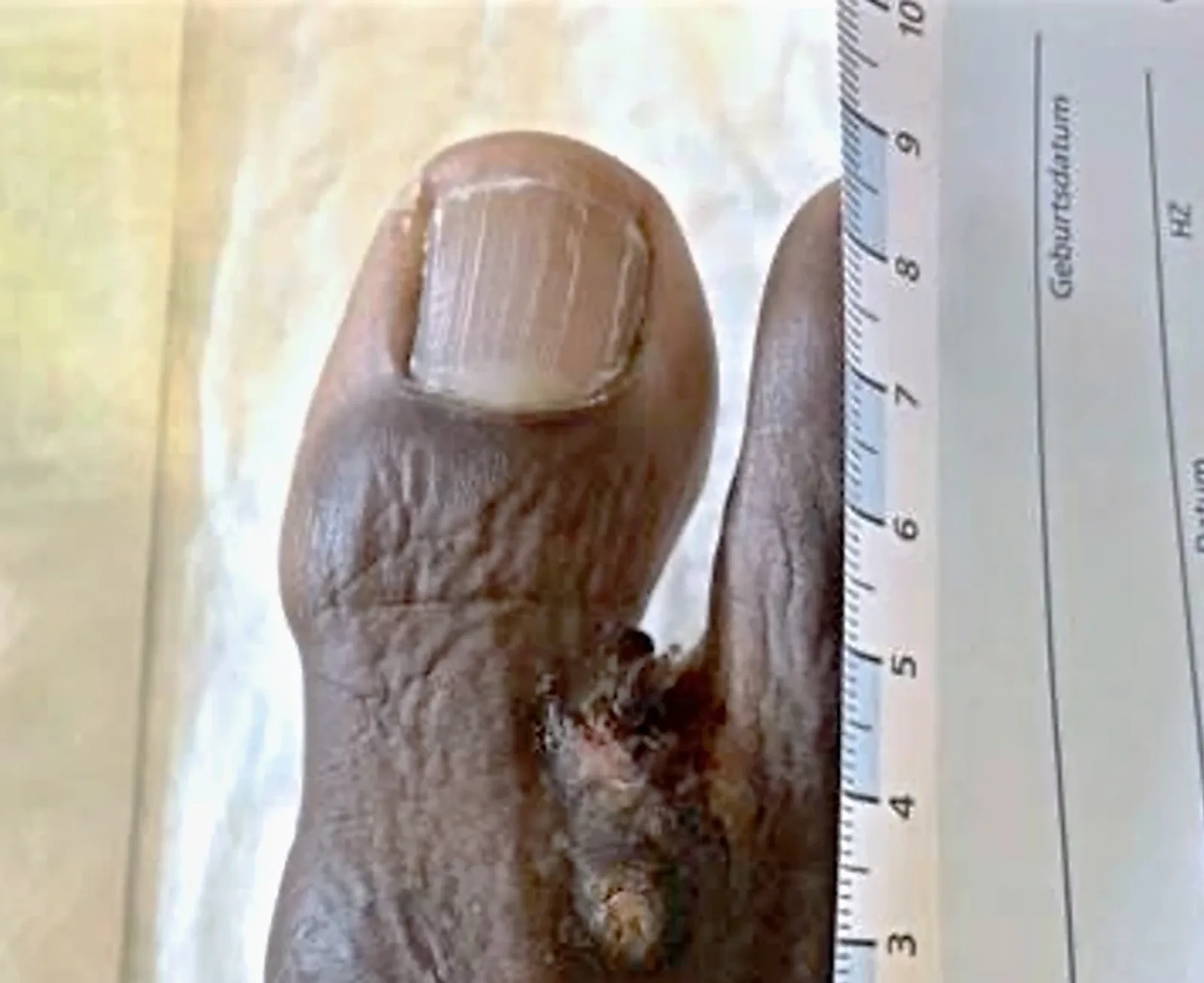 Dermatologische Nahaufnahme einer pigmentierten Hautveränderung im Zehenzwischenraum mit angelegtem Papiermaßstab zur Dokumentation
